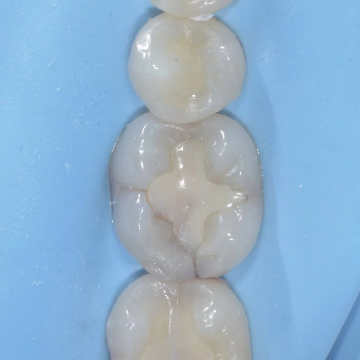 Peripheral Rim Fractures and Occlusal Effect Caries in Teeth
